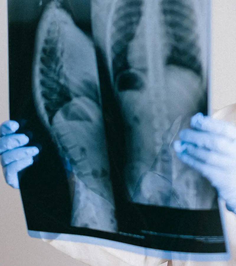 Scoliosis is a neuro-muscular disorder that causes an abnormal curve of the spine